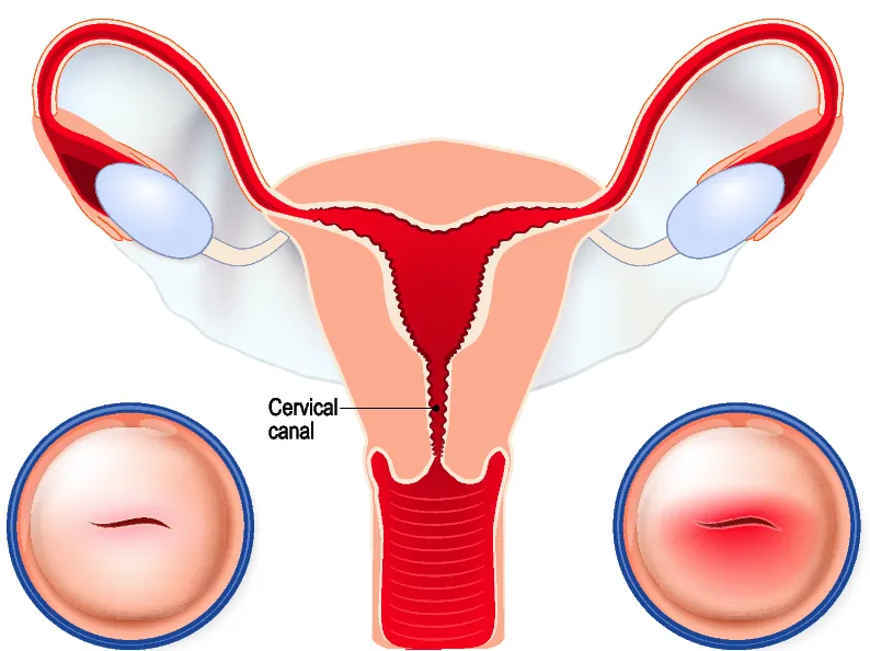 Ilustración de colposcopia